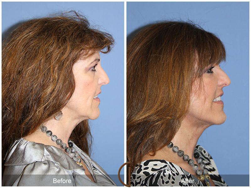 Facial Fat Grafting Before & After Photo