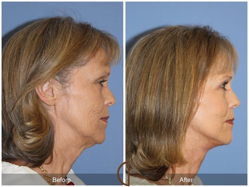 Facial Fat Grafting Before & After Photo