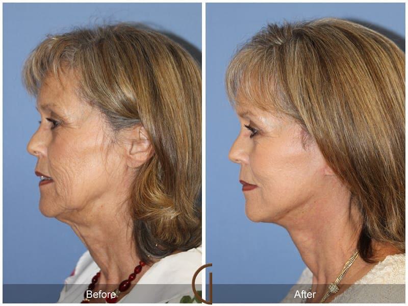 Facial Fat Grafting Before & After Photo