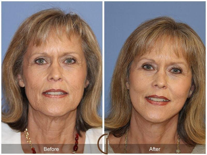 Facial Fat Grafting Before & After Photo