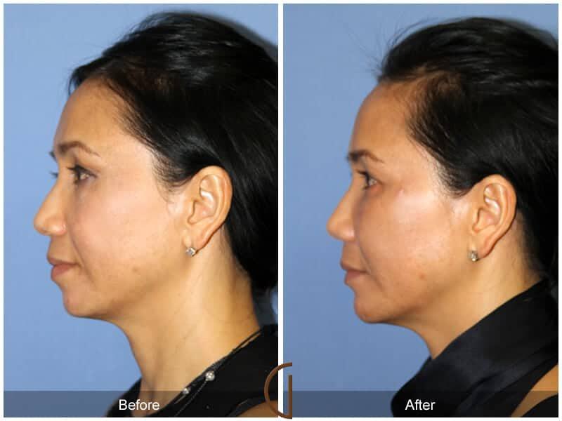 Facial Fat Grafting Before & After Photo