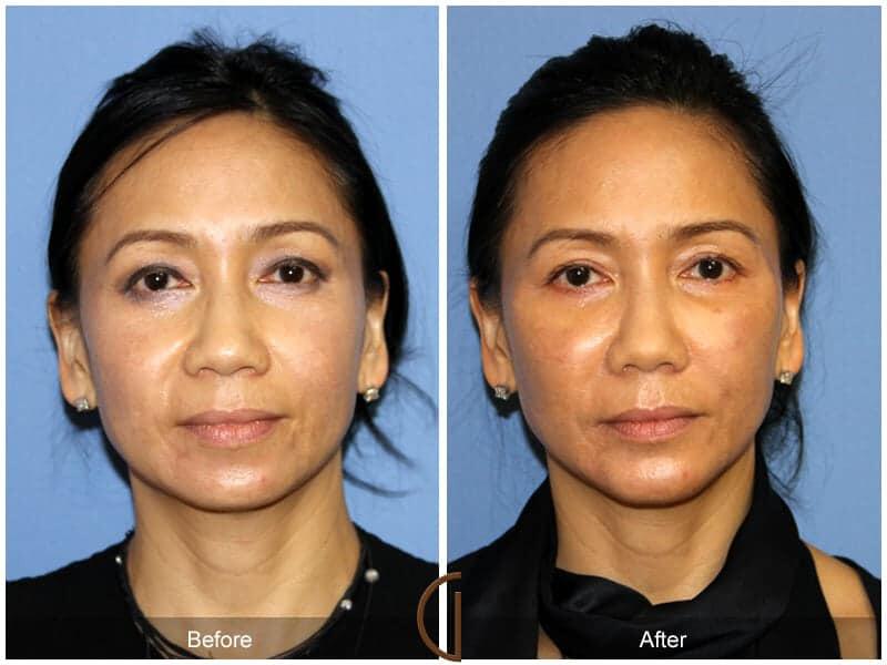 Facial Fat Grafting Before & After Photo