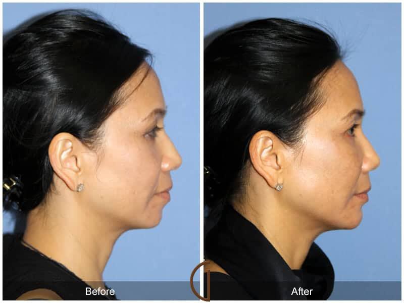 Facial Fat Grafting Before & After Photo