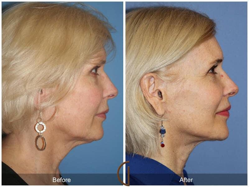 Facial Fat Grafting Before & After Photo