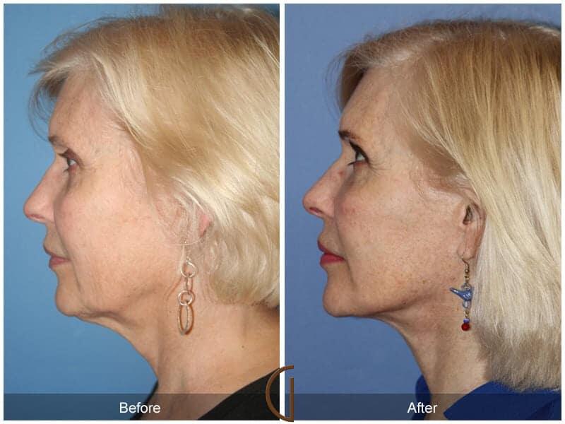 Facial Fat Grafting Before & After Photo