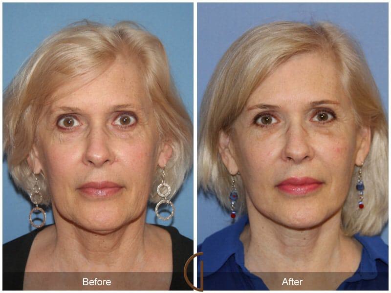 Facial Fat Grafting Before & After Photo