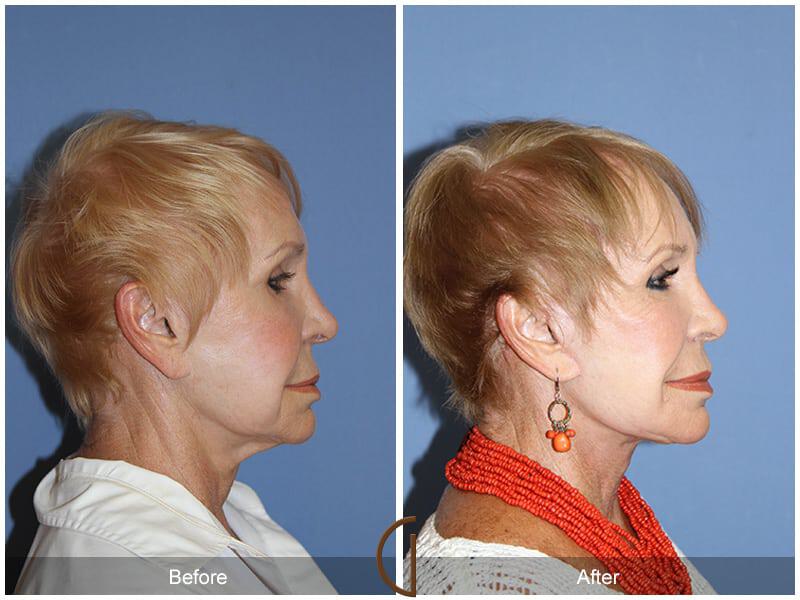 Facial Fat Grafting Before & After Photo