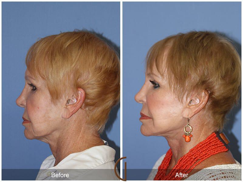 Facial Fat Grafting Before & After Photo