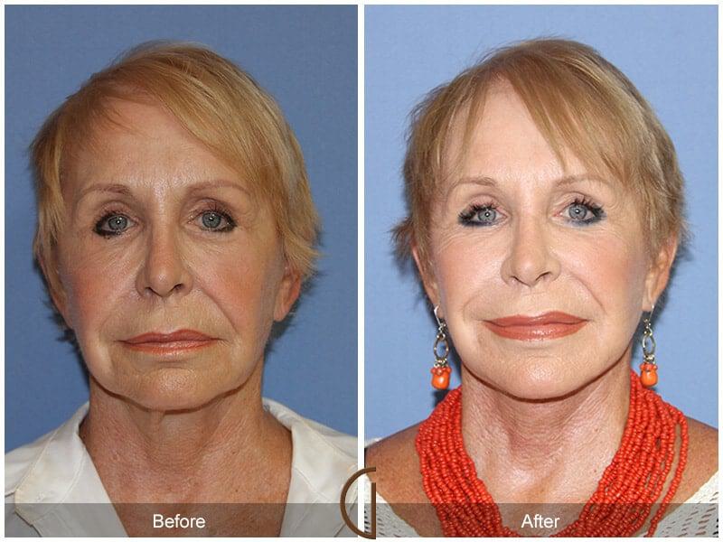 Facial Fat Grafting Before & After Photo