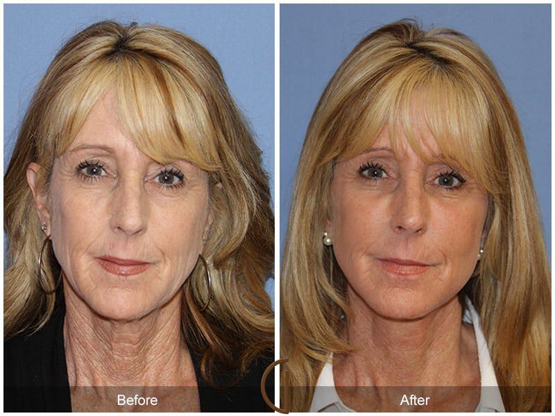 Facial Fat Grafting Before & After Photo