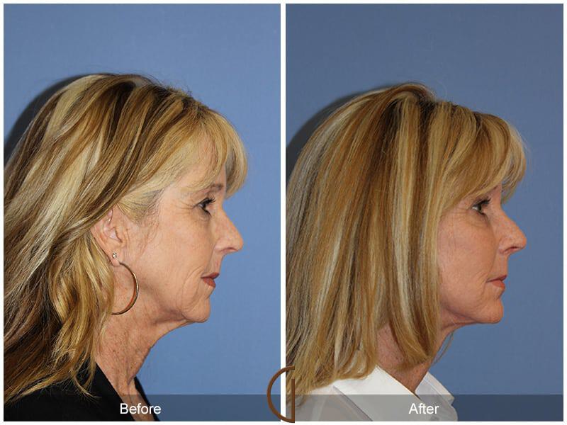 Facial Fat Grafting Before & After Photo