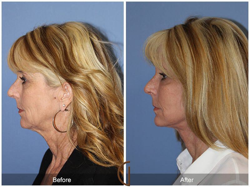 Facial Fat Grafting Before & After Photo