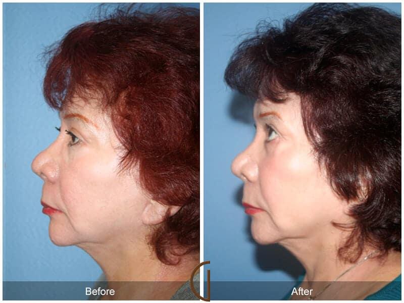 Facial Fat Grafting Before & After Photo