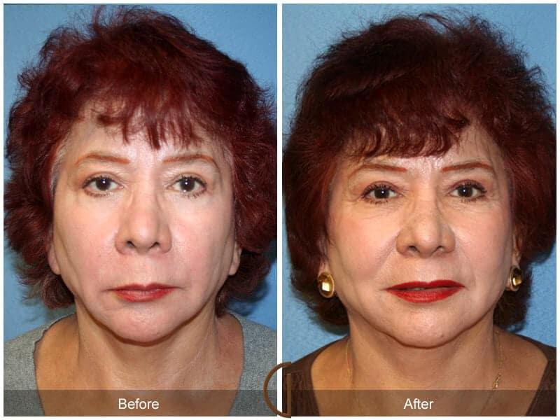 Facial Fat Grafting Before & After Photo