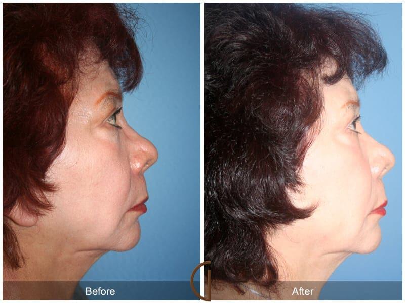 Facial Fat Grafting Before & After Photo