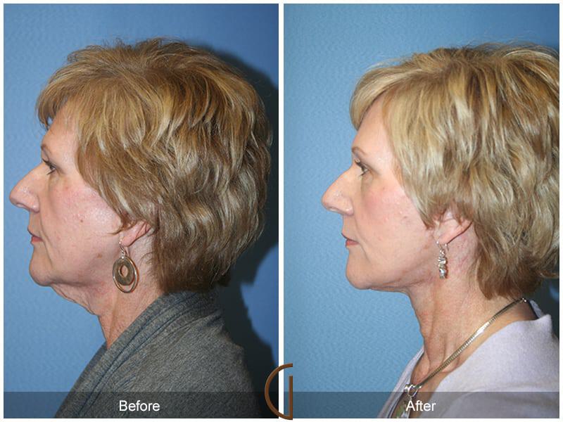 Facial Fat Grafting Before & After Photo