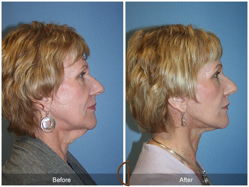 Facial Fat Grafting Before & After Photo