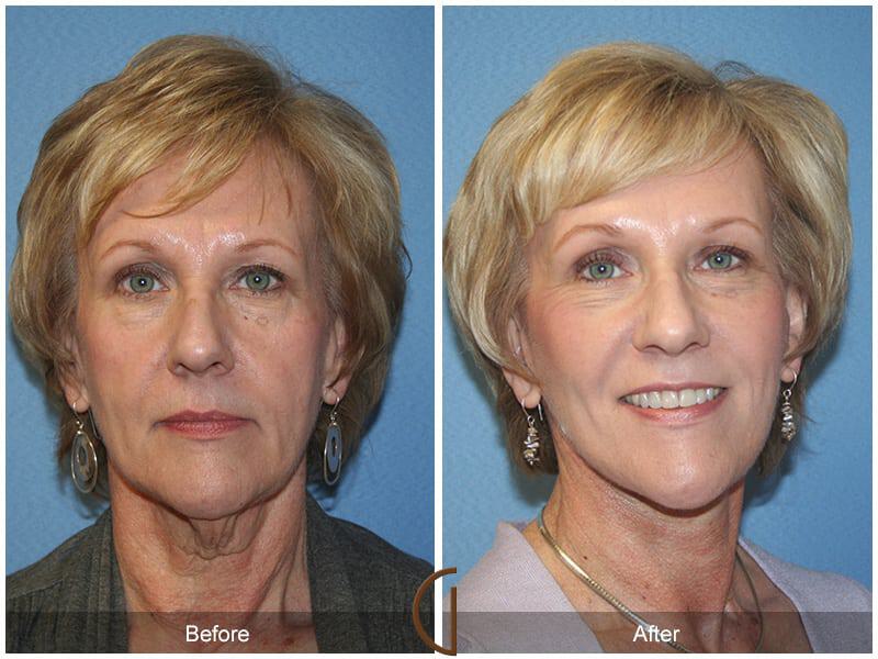 Facial Fat Grafting Before & After Photo