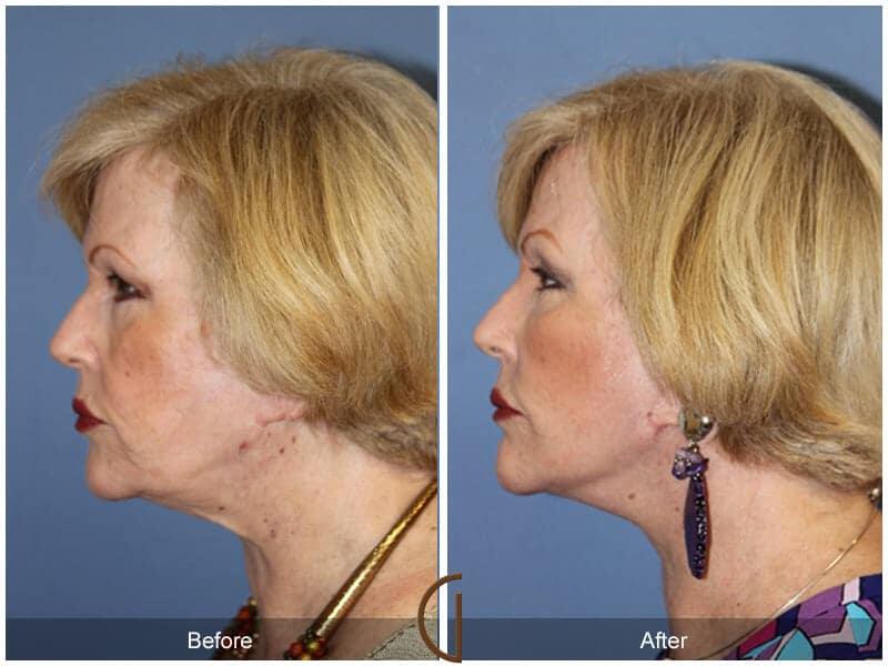 Facial Fat Grafting Before & After Photo