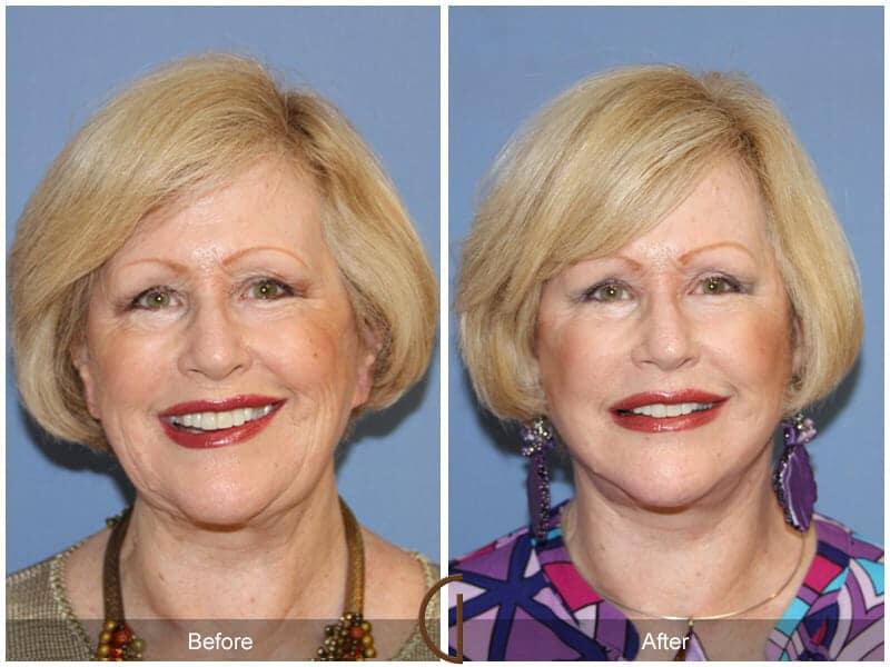 Facial Fat Grafting Before & After Photo