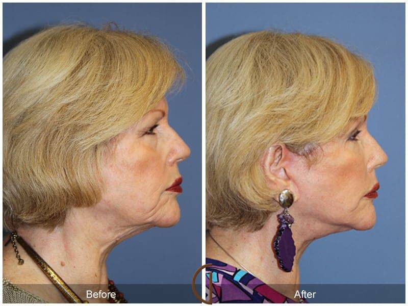 Facial Fat Grafting Before & After Photo