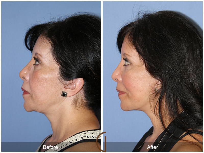 Facial Fat Grafting Before & After Photo