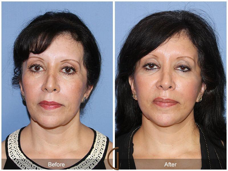 Facial Fat Grafting Before & After Photo