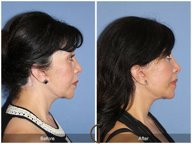 Facial Fat Grafting Before & After Photo