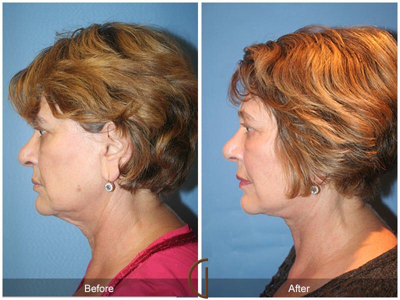 Facial Fat Grafting Before & After Photo