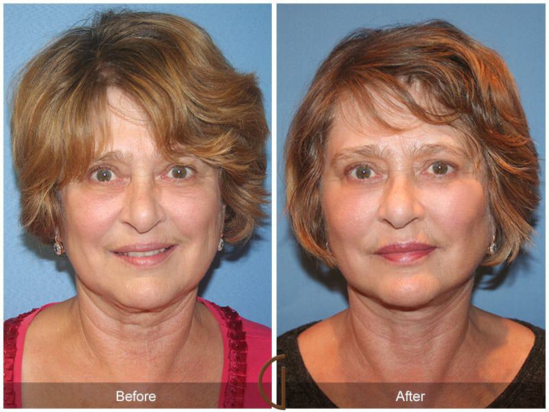 Facial Fat Grafting Before & After Photo