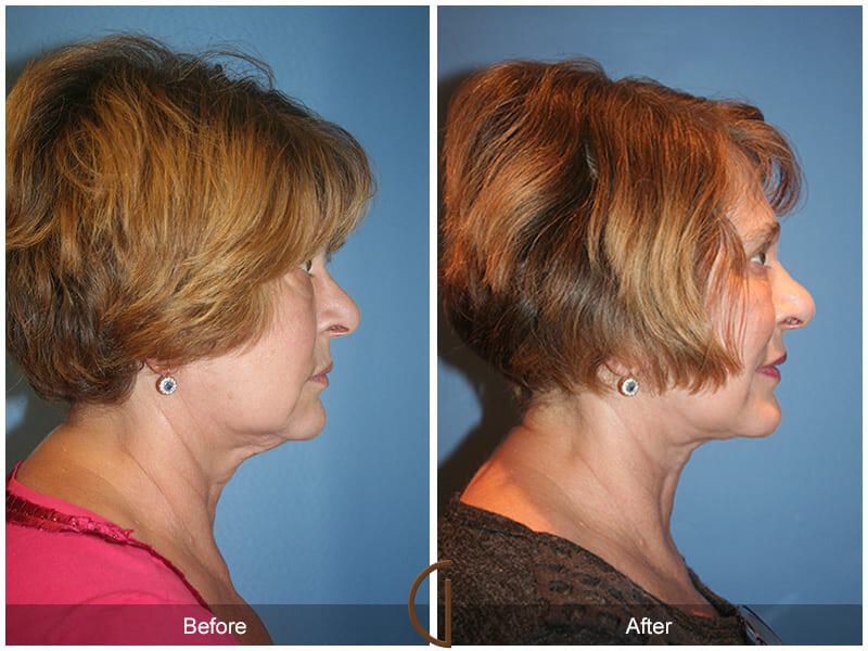 Facial Fat Grafting Before & After Photo