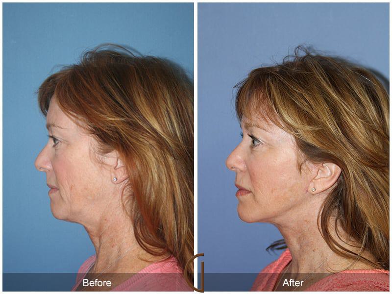 Facial Fat Grafting Before & After Photo