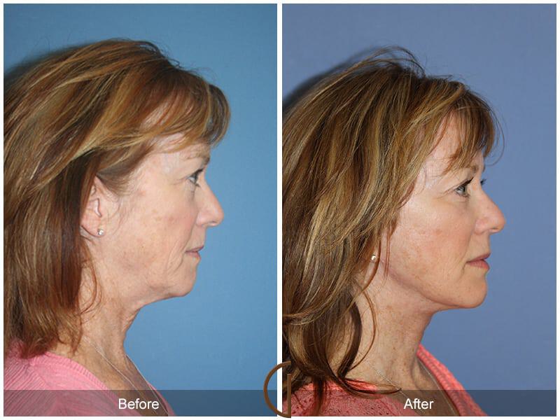 Facial Fat Grafting Before & After Photo