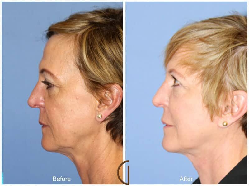 Facial Fat Grafting Before & After Photo