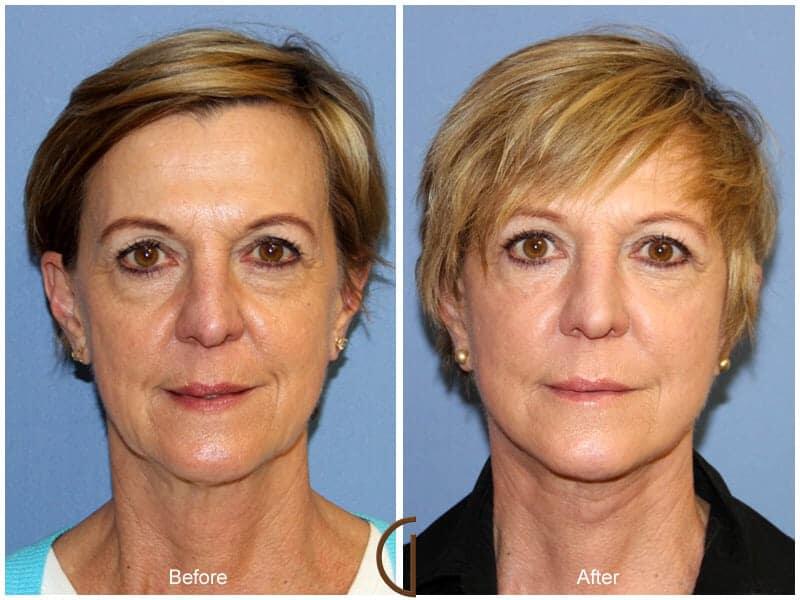 Facial Fat Grafting Before & After Photo