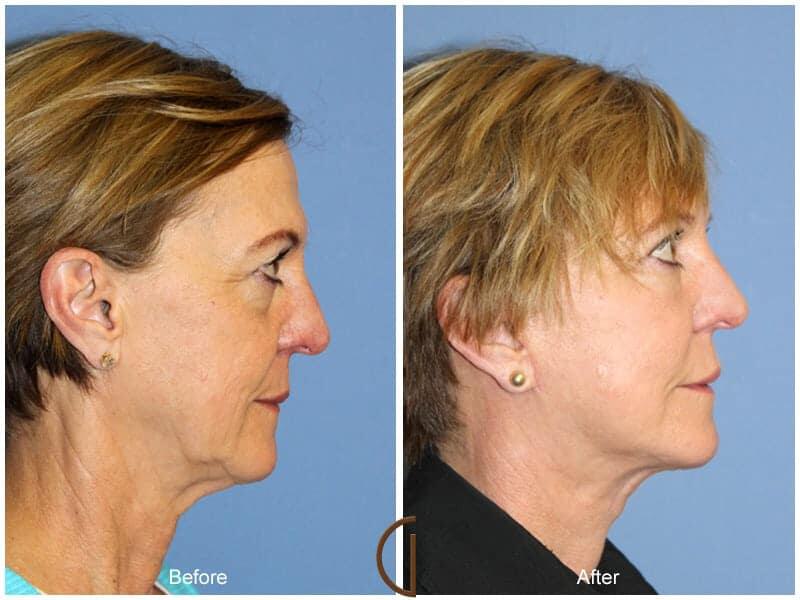 Facial Fat Grafting Before & After Photo