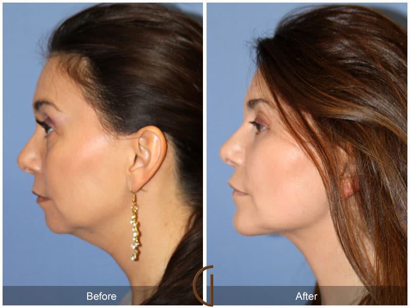 Facial Fat Grafting Before & After Photo