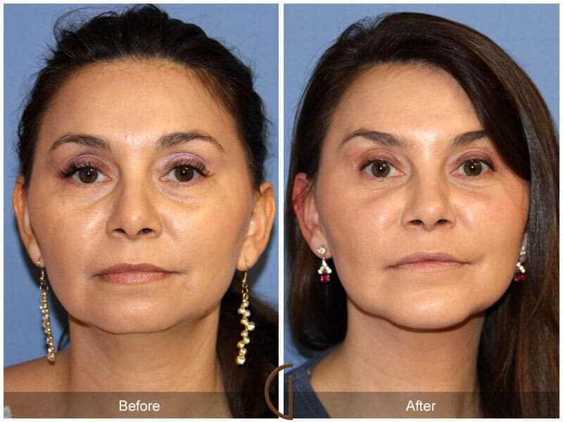 Facial Fat Grafting Before & After Photo