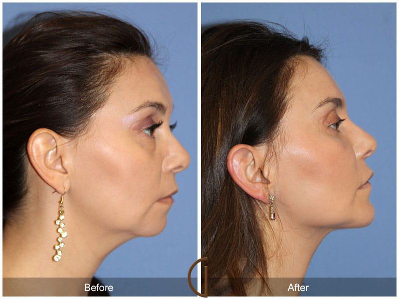 Facial Fat Grafting Before & After Photo