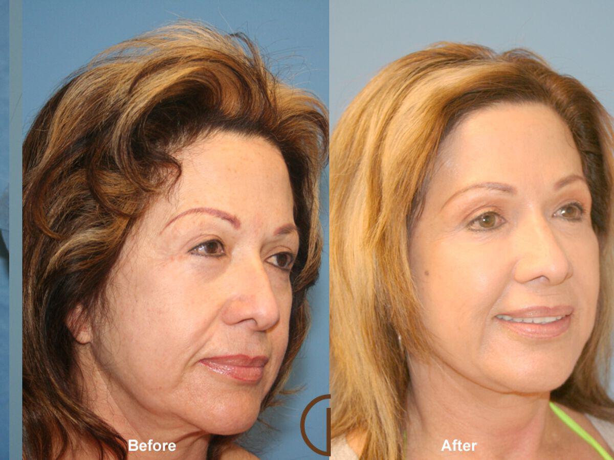 Facial Fat Grafting Before & After Photo