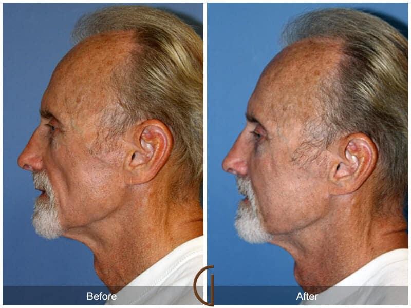 Facial Fat Grafting Before & After Photo