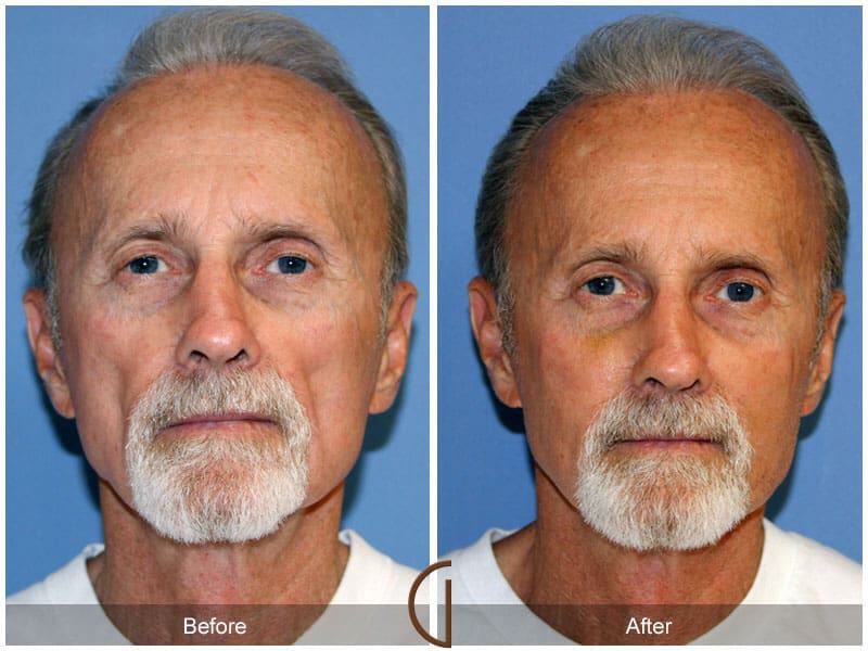 Facial Fat Grafting Before & After Photo