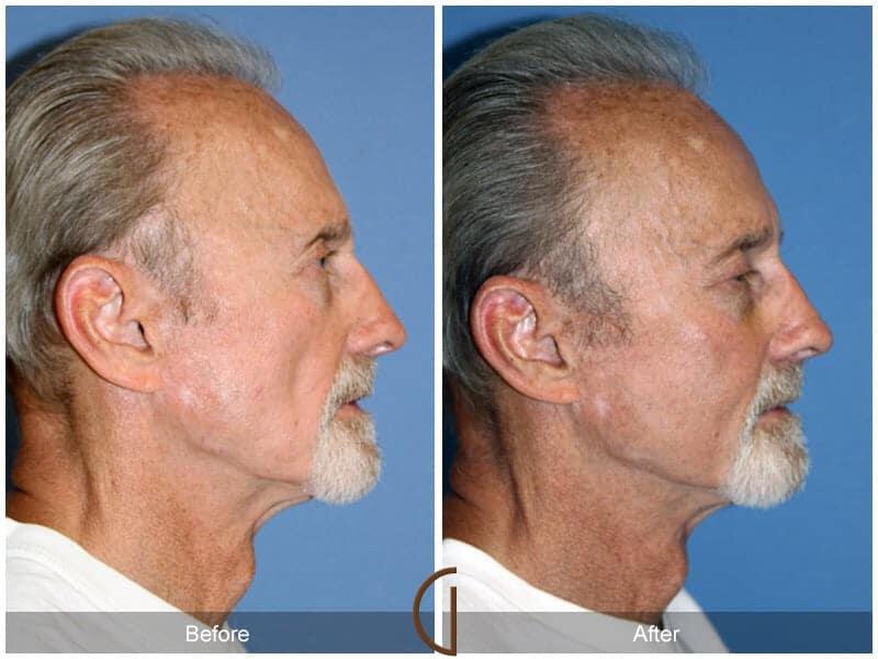 Facial Fat Grafting Before & After Photo