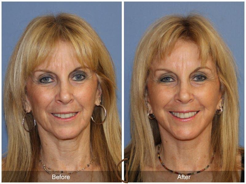 Facial Fat Grafting Before & After Photo