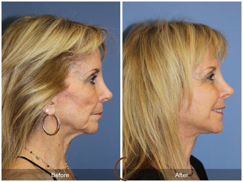 Facial Fat Grafting Before & After Photo