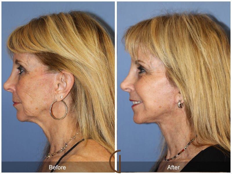 Facial Fat Grafting Before & After Photo