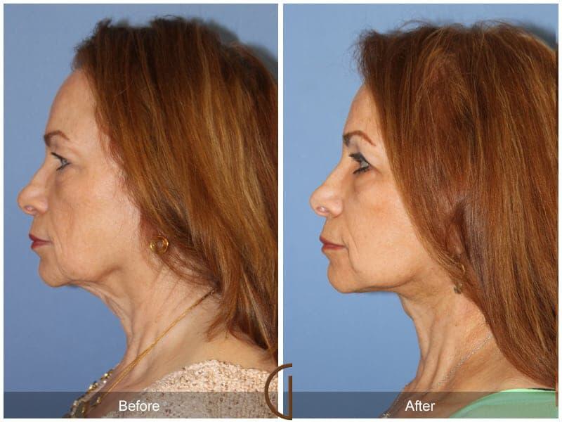 Facial Fat Grafting Before & After Photo