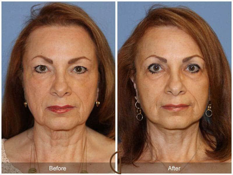 Facial Fat Grafting Before & After Photo