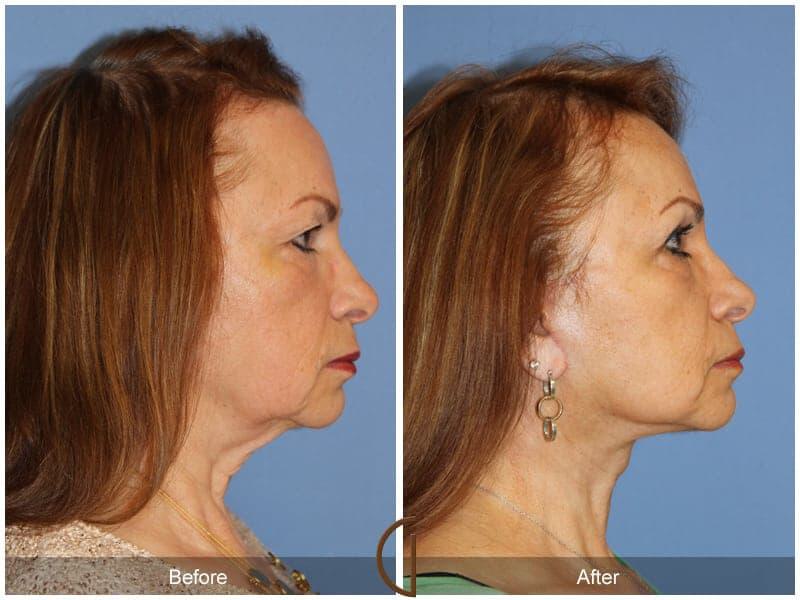 Facial Fat Grafting Before & After Photo