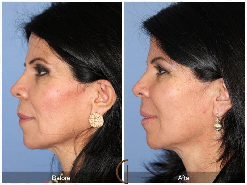 Facial Fat Grafting Before & After Photo